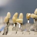 Aktualna technika wykorzystywana w salonach stomatologii estetycznej może sprawić, że odzyskamy prześliczny uśmieszek.